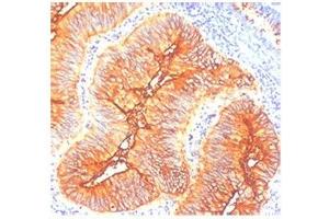 IHC staining of human colon cancer with TAG-72 antibody (TAG-72 antibody)