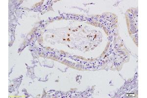 Formalin-fixed and paraffin embedded human gastric cancer labeled with Anti-VEGFR3 Polyclonal Antibody, Unconjugated (ABIN678578) at 1:200 followed by conjugation to the secondary antibody and DAB staining (FLT4 antibody  (AA 901-1000))