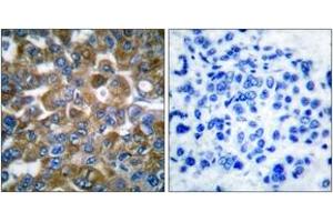 Immunohistochemistry analysis of paraffin-embedded human breast carcinoma tissue, using Keratin 15 Antibody. (KRT15 antibody  (AA 1-50))