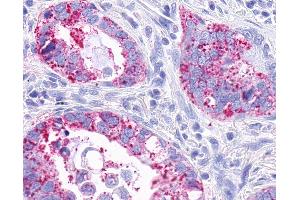 Anti-MRGPRX3 / MRGX3 antibody IHC of human Lung, Adenocarcinoma. (MRGPRX3 antibody  (Extracellular Domain))