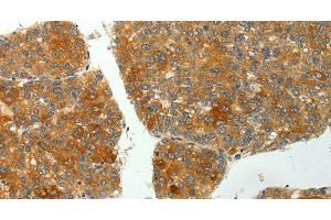 Immunohistochemistry of paraffin-embedded Human liver cancer using SH-PTP1 Polyclonal Antibody at dilution of 1:35 (SHP1 antibody)