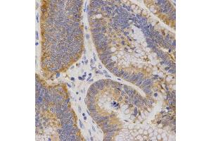 Immunohistochemistry of paraffin-embedded human rectal cancer using P2RY11 antibody (ABIN5971564) at dilution of 1/200 (40x lens). (P2RY11 antibody)