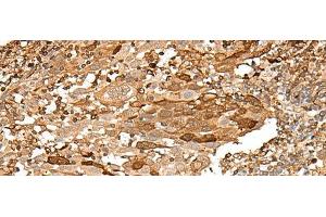Immunohistochemistry of paraffin-embedded Human cervical cancer tissue using PIEZO2 Polyclonal Antibody at dilution of 1:55(x200)