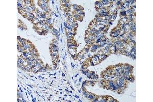 Immunohistochemistry of paraffin-embedded Human gastric cancer using ATP5B Polyclonal Antibody at dilution of 1:100 (40x lens). (ATP5B antibody)