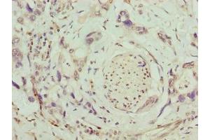 Immunohistochemistry of paraffin-embedded human pancreatic cancer using ABIN7171798 at dilution of 1:100 (SLC26A8 antibody  (AA 414-595))