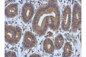 IHC-P Image Immunohistochemical analysis of paraffin-embedded human colon carcinoma, using DNAJB12, antibody at 1:500 dilution. (DNAJB12 antibody  (Center))