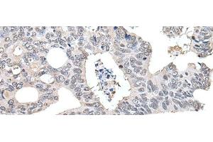 Immunohistochemistry of paraffin-embedded Human colorectal cancer tissue using TCEB2 Polyclonal Antibody at dilution of 1:40(x200)