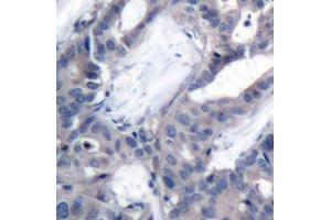 Immunohistochemistry of paraffin-embedded human breast carcinoma using Phospho-MAP2K2-T394 antibody (ABIN2987359). (MEK2 antibody  (pThr394))