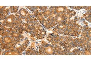 Immunohistochemistry of paraffin-embedded Human thyroid cancer tissue using SCT Polyclonal Antibody at dilution 1:40 (Secretin antibody)