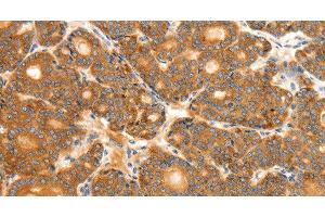 Immunohistochemistry of paraffin-embedded Human thyroid cancer tissue using SCT Polyclonal Antibody at dilution 1:40