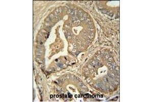 ISCA2 antibody (Center) (ABIN654448 and ABIN2844182) immunohistochemistry analysis in formalin fixed and paraffin embedded human prostate carcinoma followed by peroxidase conjugation of the secondary antibody and DAB staining. (ISCA2 antibody  (AA 72-101))