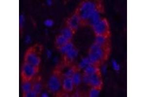 Immunofluorescence analysis of Human liver cancer tissue using NFKBIB Monoclonal Antibody at dilution of 1:200. (NFKBIB antibody)