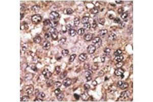 IHC analysis of FFPE human hepatocarcinoma tissue stained with the SIRT5 antibody (SIRT5 antibody  (AA 263-292))