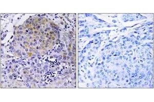 Immunohistochemistry analysis of paraffin-embedded human breast carcinoma tissue, using CEP78 Antibody. (CEP78 antibody  (AA 301-350))