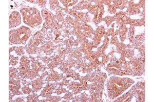 IHC-P Image IGF1 antibody detects IGF1 protein at cytoplasm on human breast carcinoma by immunohistochemical analysis. (IGF1 antibody)