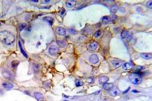 Immunohistochemistry (IHC) analyzes of p-EGFR antibody in paraffin-embedded human breast carcinoma tissue. (EGFR antibody  (pTyr1197))