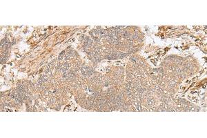 Immunohistochemistry of paraffin-embedded Human esophagus cancer tissue using FBXW8 Polyclonal Antibody at dilution of 1:65(x200) (FBXW8 antibody)
