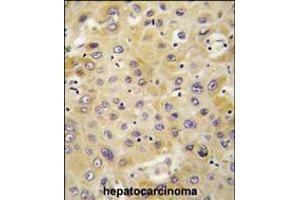 Formalin-fixed and paraffin-embedded human hepatocarcinoma tissue reacted with PPBP antibody , which was peroxidase-conjugated to the secondary antibody, followed by DAB staining. (PEBP1 antibody  (C-Term))