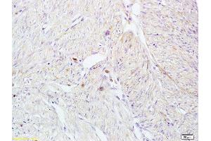 Formalin-fixed and paraffin embedded human breast carcinoma tissue labeled with Anti-CD161 Polyclonal Antibody, Unconjugated at 1:200 followed by conjugation to the secondary antibody and DAB staining