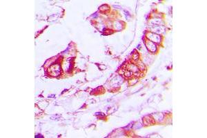 Immunohistochemical analysis of APLP2 staining in human lung cancer formalin fixed paraffin embedded tissue section. (APLP2 antibody  (Center))