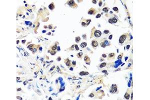 Immunohistochemistry of paraffin-embedded Human lung cancer using CAND1 Polyclonal Antibody at dilution of 1:100 (40x lens).