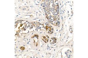 Immunohistochemistry of paraffin-embedded human breast cancer using MMP7 Rabbit mAb (ABIN7268425) at dilution of 1:150 (40x lens). (MMP7 antibody)