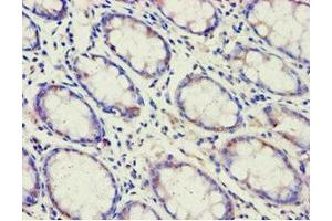 Immunohistochemistry of paraffin-embedded human colon cancer using ABIN7143191 at dilution of 1:100 (ACAD9 antibody  (AA 1-270))