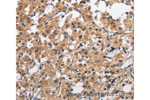 Immunohistochemistry of Human liver cancer using CLEC2D Polyclonal Antibody at dilution of 1:70 (CLEC2D antibody)
