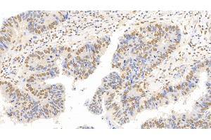 Detection of FOXP3 in Human Colorectal cancer Tissue using Monoclonal Antibody to Forkhead Box P3 (FOXP3) (FOXP3 antibody  (AA 191-412))