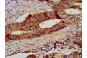 IHC image of ABIN7145452 diluted at 1:300 and staining in paraffin-embedded human colon cancer performed on a Leica BondTM system. (CSN2 antibody  (AA 16-226))