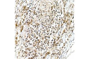 Immunohistochemistry of paraffin-embedded human colon carcinoma using TCF1/TCF7 Rabbit mAb (ABIN7270885) at dilution of 1:100 (40x lens). (TCF7 antibody)