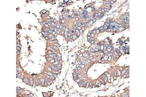 Immunohistochemistry of paraffin-embedded Human colon carcinoma using KRT81 Polyclonal Antibody at dilution of 1:100 (40x lens).