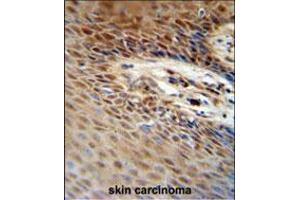 ZNF324B antibody immunohistochemistry analysis in formalin fixed and paraffin embedded human skin carcinoma followed by peroxidase conjugation of the secondary antibody and DAB staining. (ZNF324B antibody  (C-Term))