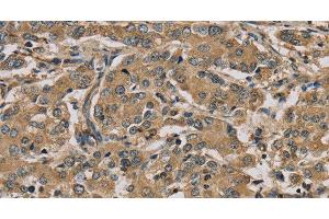 Immunohistochemistry of paraffin-embedded Human liver cancer using MYL3 Polyclonal Antibody at dilution of 1:45 (MYL3/CMLC1 antibody)