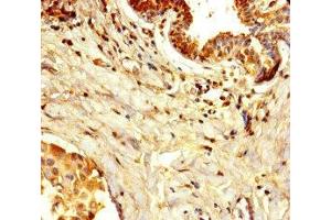 Immunohistochemistry of paraffin-embedded human breast cancer using ABIN7150005 at dilution of 1:100