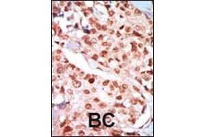 Formalin-fixed and paraffin-embedded human cancer tissue reacted with the primary antibody, which was peroxidase-conjugated to the secondary antibody, followed by DAB staining. (PRKAA2 antibody  (AA 265-295))