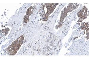 IHC-P Image Immunohistochemical analysis of paraffin-embedded human ovarian cancer, using GLO1, antibody at 1:100 dilution. (GLO1 antibody)