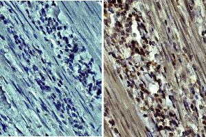 Paraffin embedded human gastric cancer tissue was stained with Mouse IgG2a-HRP isotype control. (MMP 9 antibody  (HRP))