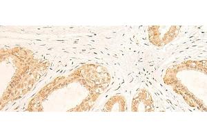 Immunohistochemistry of paraffin-embedded Human breast cancer tissue using IFI35 Polyclonal Antibody at dilution of 1:35(x200) (IFI35 antibody)