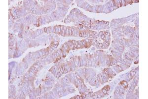 IHC-P Image Immunohistochemical analysis of paraffin-embedded human colon carcinoma, using Casein Kinase 1 alpha 1L, antibody at 1:500 dilution.