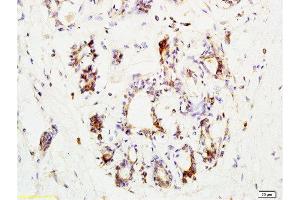 Formalin-fixed and paraffin embedded human breast carcinoma labeled with Anti-CCR3 Polyclonal Antibody, Unconjugated  at 1:200 followed by conjugation to the secondary antibody and DAB staining. (CCR3 antibody  (AA 251-355))