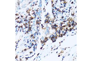 Immunohistochemistry of paraffin-embedded human lung cancer using SPN antibody (ABIN5973813) at dilution of 1/100 (40x lens). (CD43 antibody)