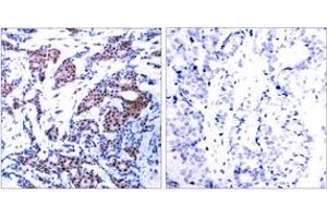 Immunohistochemistry analysis of paraffin-embedded human breast carcinoma, using c-Jun (Phospho-Ser73) Antibody.