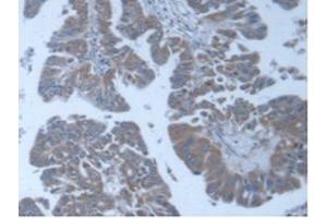 IHC-P analysis of Human Liver Cancer Tissue, with DAB staining. (POFUT1 antibody  (AA 238-388))