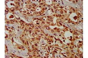 IHC image of ABIN7146668 diluted at 1:300 and staining in paraffin-embedded human liver cancer performed on a Leica BondTM system. (CPS1 antibody  (AA 1361-1500))