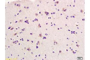 Formalin-fixed and paraffin embedded human glioma labeled with Anti-Elastin Polyclonal Antibody, Unconjugated (ABIN734003) at 1:200 followed by conjugation to the secondary antibody and DAB staining. (Elastin antibody  (AA 681-786))