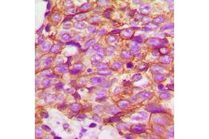 Immunohistochemical analysis of ECHOS1 staining in human breast cancer formalin fixed paraffin embedded tissue section. (TMPRSS3 antibody  (C-Term))