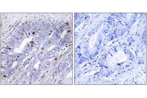 Immunohistochemistry analysis of paraffin-embedded human colon carcinoma tissue, using Nuclear Receptor NR4A1 (Ab-351) Antibody.
