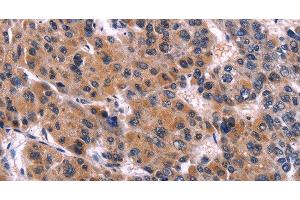 Immunohistochemistry of paraffin-embedded Human liver cancer tissue using EIF2AK4 Polyclonal Antibody at dilution 1:50 (GCN2 antibody)