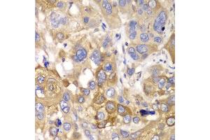 Immunohistochemistry of paraffin-embedded human esophageal cancer using PPP1CB antibody at dilution of 1:100 (400x lens). (PPP1CB antibody)